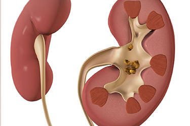 Thumbnail image for "Kidney Stones: Fast Facts"
