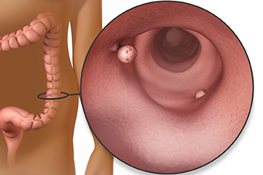 Thumbnail image for "Colon Polyps: Fast Facts"