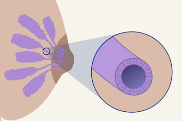 Thumbnail image for "¿Qué es el Carcinoma Ductal In Situ (DCIS)?"