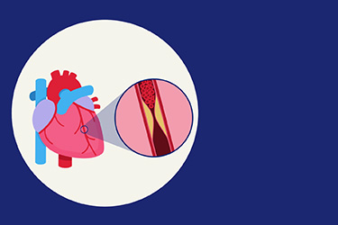 Thumbnail image for "Answers to Common Questions about Cardiac Catheterization"