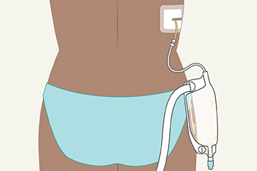 Thumbnail image for "Caring for a Nephrostomy Tube"