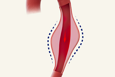 Thumbnail image for "Thoracic Aortic Aneurysm"