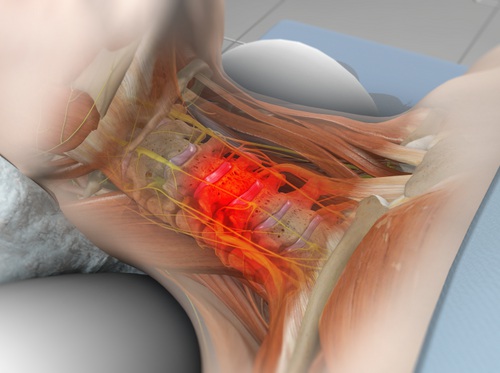 Thumbnail image for "Discectomía y fusión cervical anterior (DFCA)"