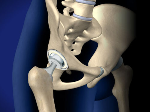 Thumbnail image for "Total Hip Replacement, Anterior Approach"