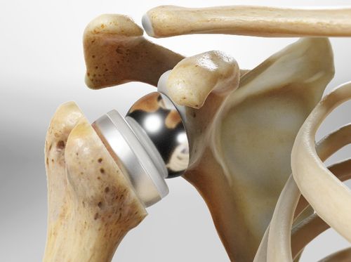 Thumbnail image for "Reverse Total Shoulder Replacement"