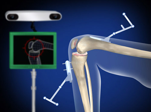 Thumbnail image for "Total Knee Replacement (Computer-Assisted Robotic Knee Replacement)"