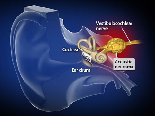 Video - Acoustic Neuroma - HealthClips Online