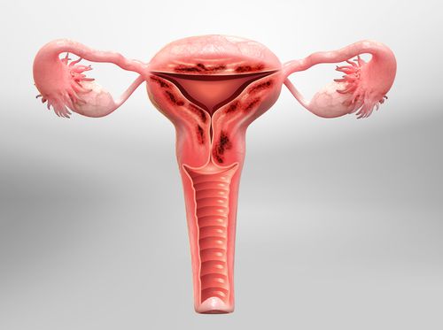 Thumbnail image for "Adenomyosis"