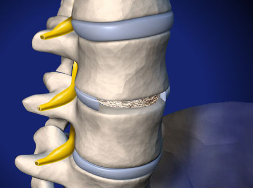 Thumbnail image for "Fusión lumbar inter-corpórea anterior (con injerto óseo y placa de metal)"