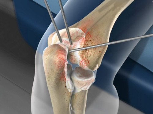 Thumbnail image for "Arthroscopic Debridement of the Elbow"