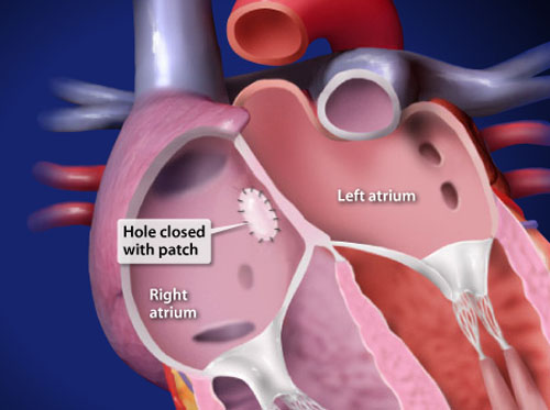 Video - Atrial Septal Defect Repair Surgery - HealthClips Online