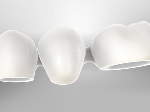 Thumbnail image for "Puente dental (prótesis parcial fija)"
