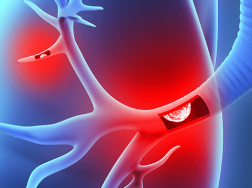 Thumbnail image for "Carcinoid Tumors of the Lung"