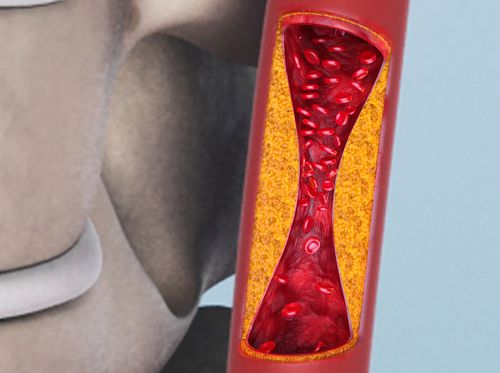 Thumbnail image for "Carotid Artery Surgery (Endarterectomy)"