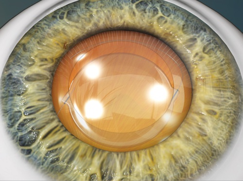 Thumbnail image for "Cataract Removal (Phacoemulsification Method)"