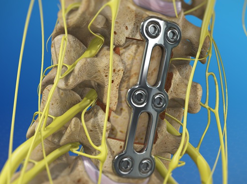 video corpectomía cervical anterior injerto óseo healthclips online