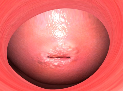 Thumbnail image for "Cervical Dysplasia"