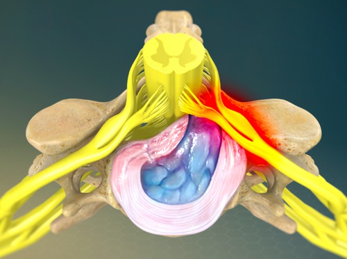 Video - Herniated Disc - Chiropractic - Healthclips Online