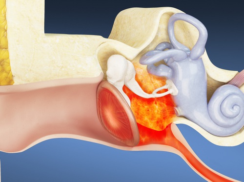 Thumbnail image for "Chronic Ear Infections in Children"