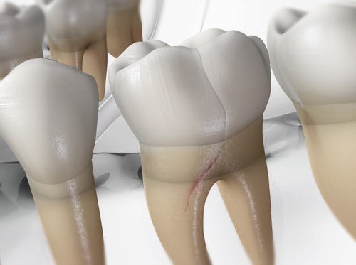 Thumbnail image for "Síndrome del diente fisurado (SDF)"