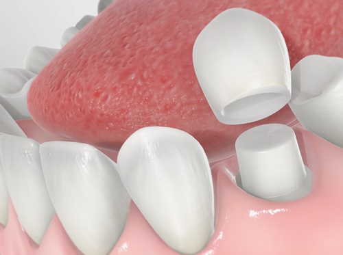 Thumbnail image for "Corona dental"