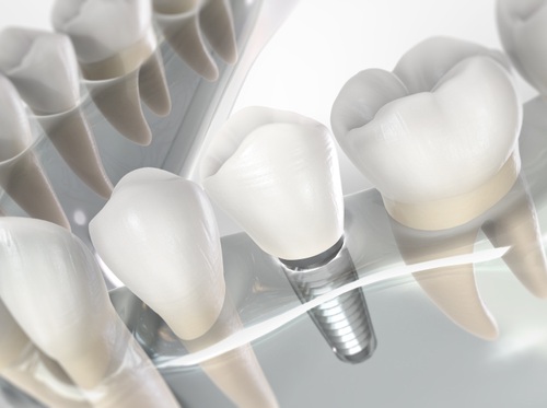 Thumbnail image for "Dental Implant"