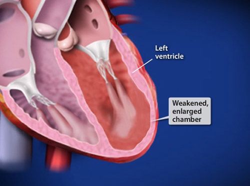 Thumbnail image for "Cardiomiopatía dilatada (CMD)"