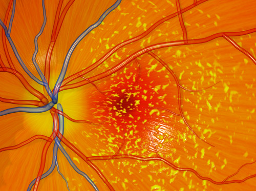 Thumbnail image for "Degeneración macular asociada a la edad, tipo seco (DMAE seca)"