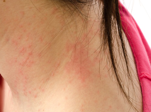 Thumbnail image for "Eczema"