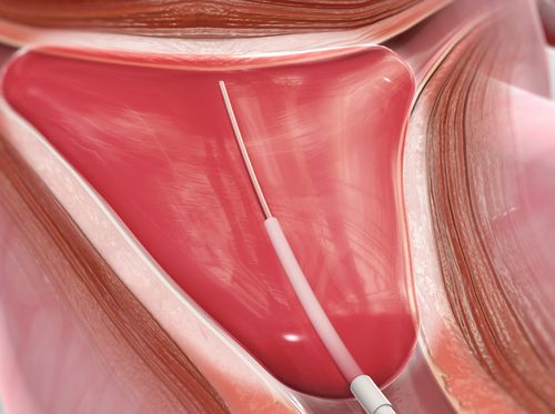 Thumbnail image for "Endometrial Ablation (Balloon Method)"