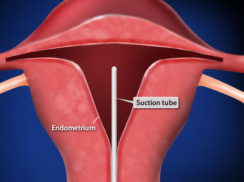 Video Endometrial Biopsy HealthClips Online