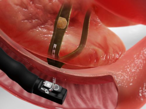 Video - Endoscopic Retrograde Cholangiopancreatogram (ERCP ...