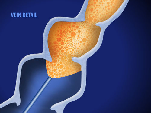 Thumbnail image for "Endovenous Foam Treatment (EVFT) for Varicose Veins"