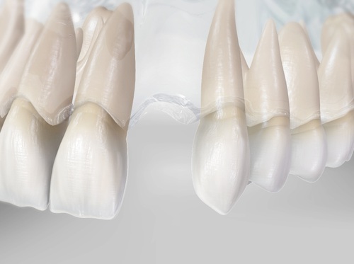Thumbnail image for "Extracción dental"