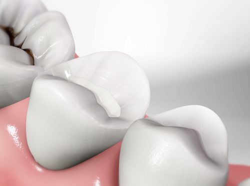Thumbnail image for "Dental Fillings"