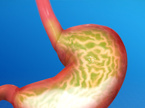 Thumbnail image for "Gastroesophageal Reflux Disease (GERD)"