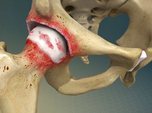 Thumbnail image for "Osteoarthritis of the Hip"