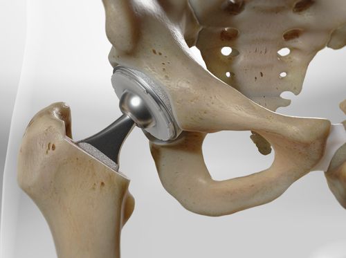 Thumbnail image for "Total Hip Replacement, Anterior Approach (Accolade® II)"