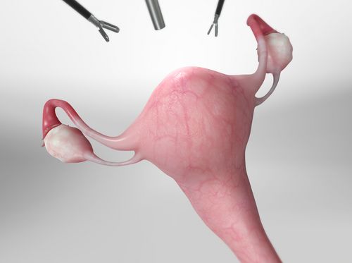 Thumbnail image for "Histerectomía (asistida por robot)"