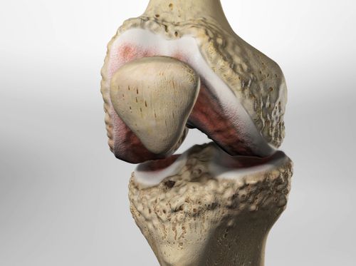 Thumbnail image for "Osteoarthritis of the Knee"