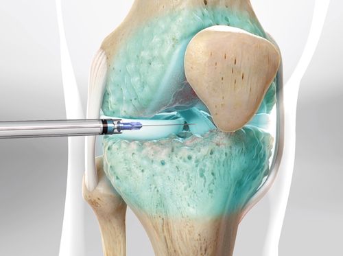 Video - Steroid Injection for Knee Pain (Fluoroscopic-Guided Method ...
