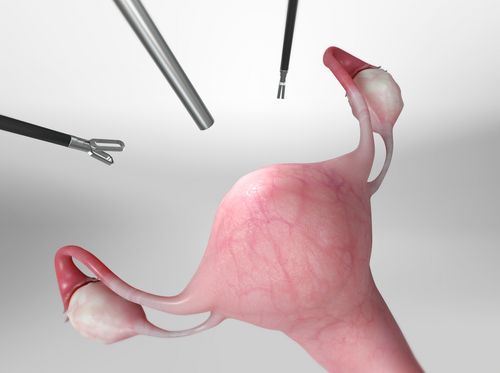 Thumbnail image for "Laparoscopic Supracervical Hysterectomy (LSH)"