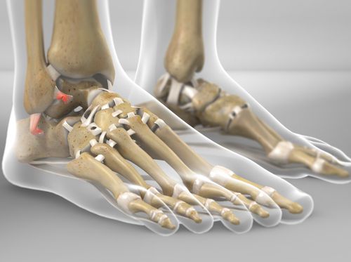 Video - Lateral Ankle Ligament Reconstruction (ALR) - HealthClips Online