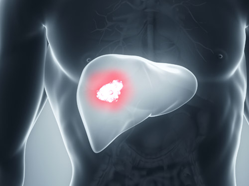 Thumbnail image for "Cáncer de hígado (Carcinoma hepatocelular)"