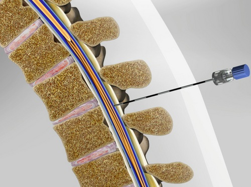 Thumbnail image for "Diagnostic Lumbar Puncture (Spinal Tap)"