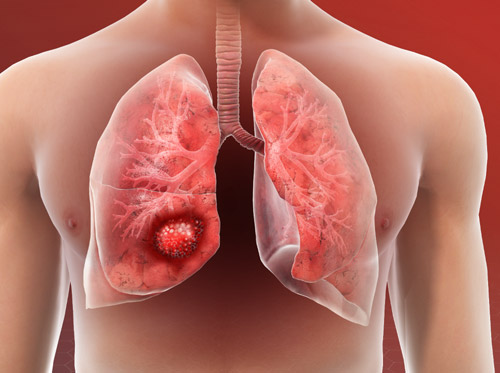 Thumbnail image for "Lung Cancer"