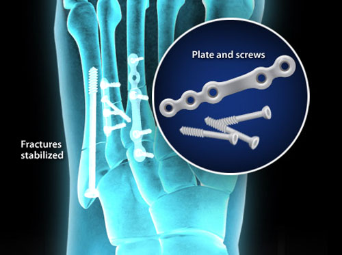 Video - Metatarsal Fracture Fixation (Open Reduction and Internal ...