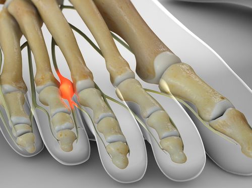 Video - Morton's Neuroma Surgery - HealthClips Online