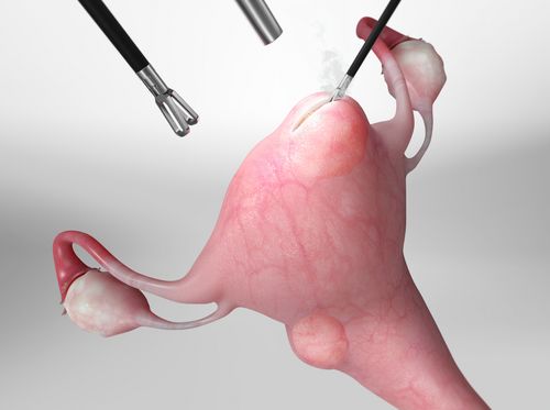 Thumbnail image for "Miomectomía de fibromas uterinos (asistida por robot)"