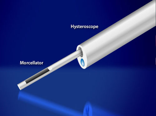 Thumbnail image for "Myomectomy (Hysteroscopic Morcellator)"